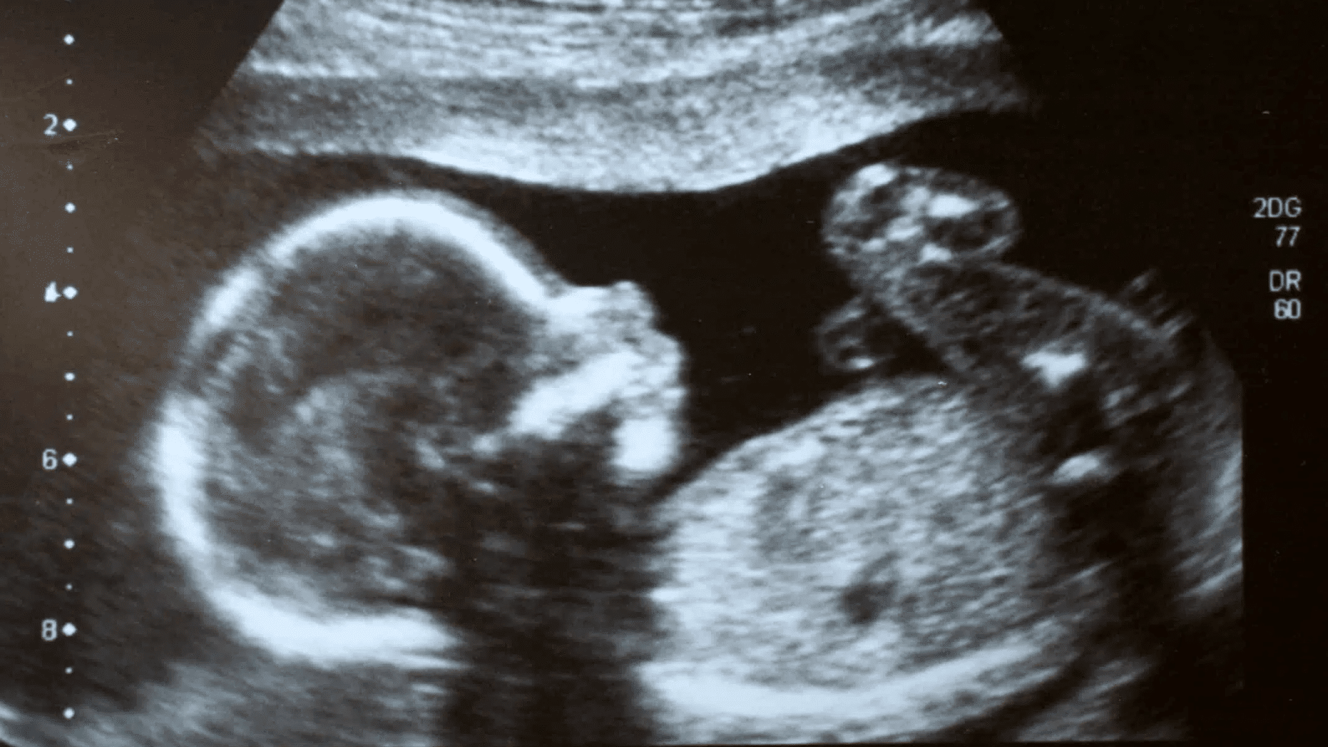 Ultraschallbild eines Kindes im Bauch seiner Mutter.